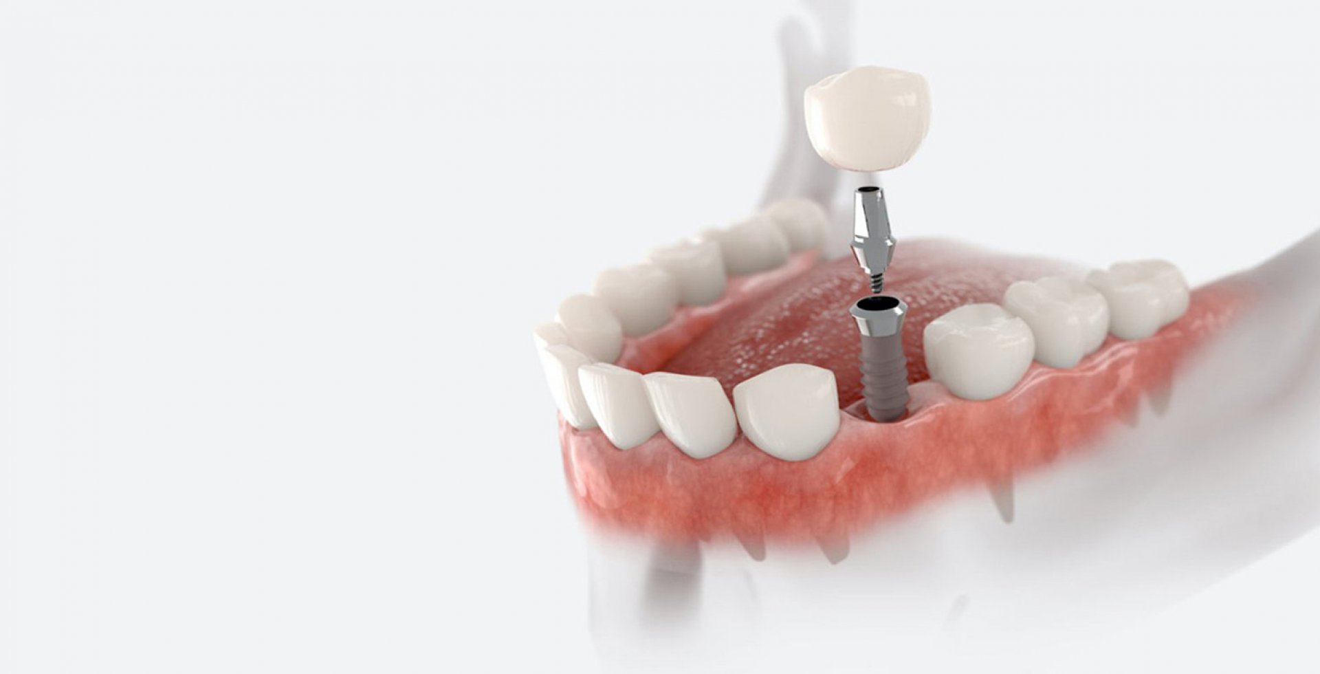 İmplant ve Çene Cerrahi