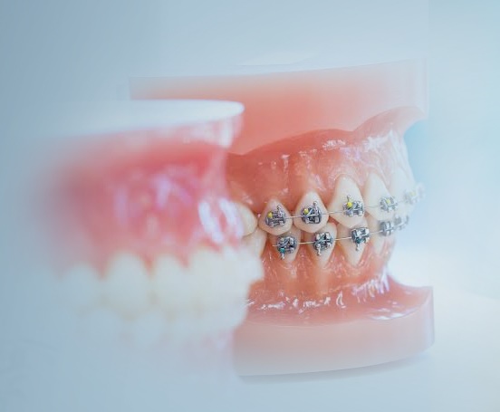 Kayseri Ortodonti Uzmanı - Kayseri Diş Teli Fiyatları