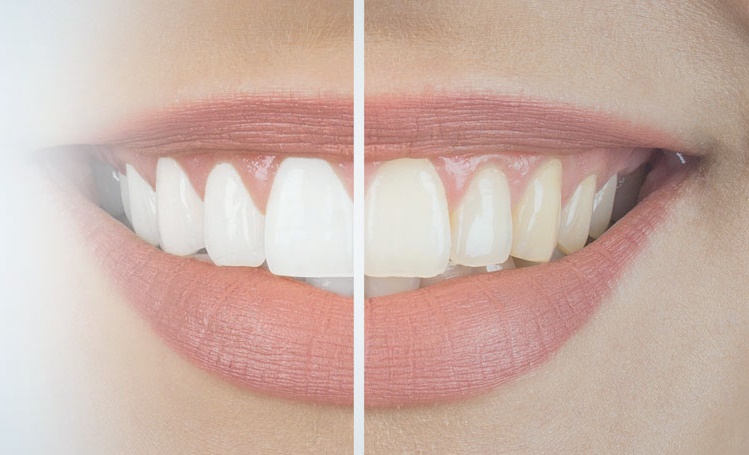 Kayseri Diş Beyazlatma Tedavisi ve Güncel Fiyatları - Gürses Dental