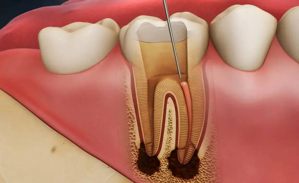 Endodonti