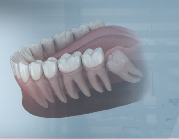 Kayseri Gömülü 20 Yaş Dişi Çekimi ve Tedavisi - Gürses Dental