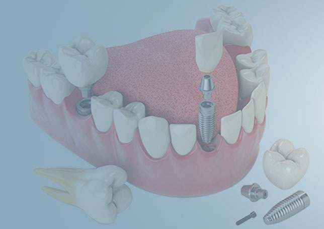 Kayseri İmplant Diş Tedavisi ve Güncel Fiyatları - Gürses Dental