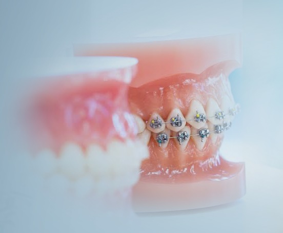 Konya Ortodonti Diş Teli Tedavisi ve Güncel Fiyatları - Gürses Dental